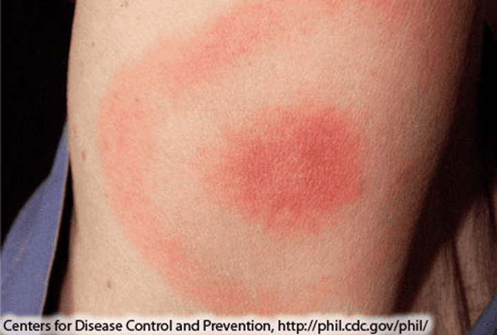 lyme disease