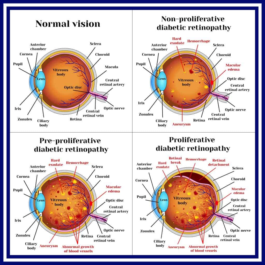 Diabetic Eye Problems