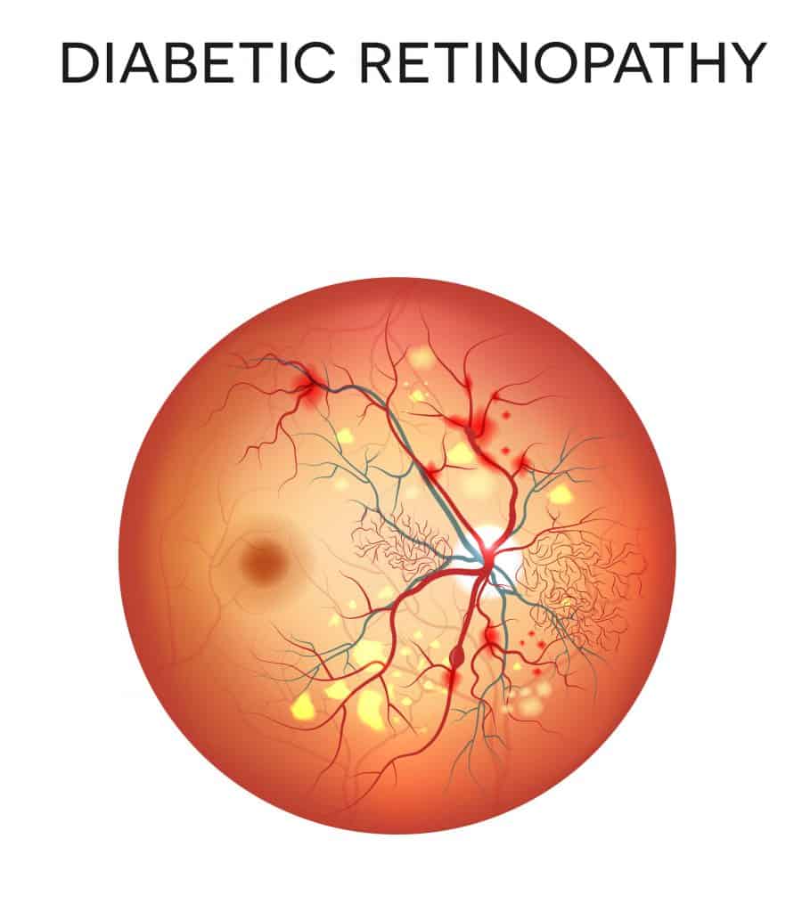 Diabetic Eye Problems