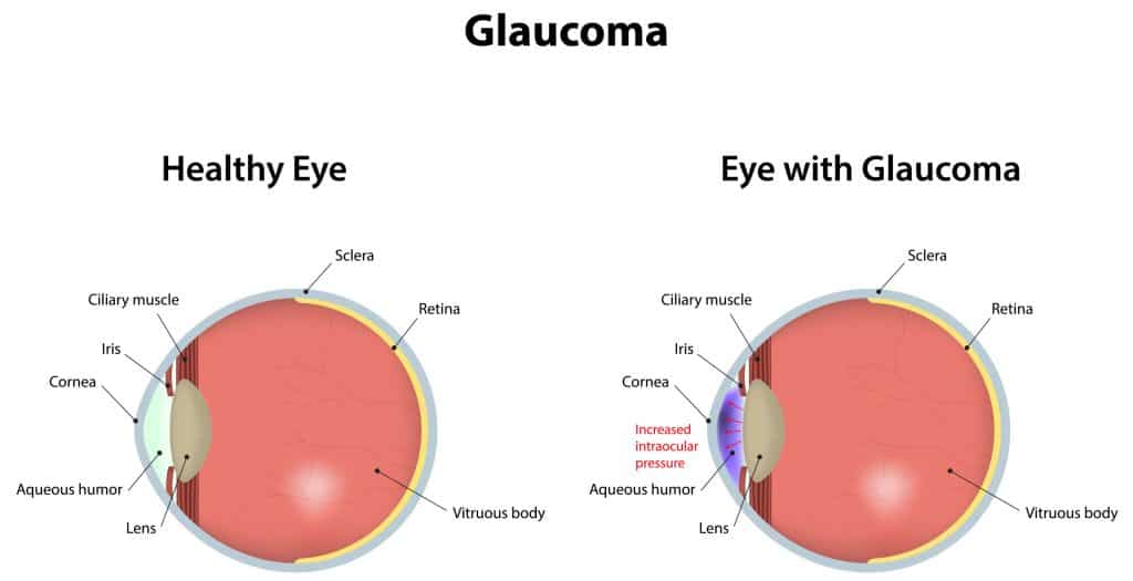 CBD and Glaucoma