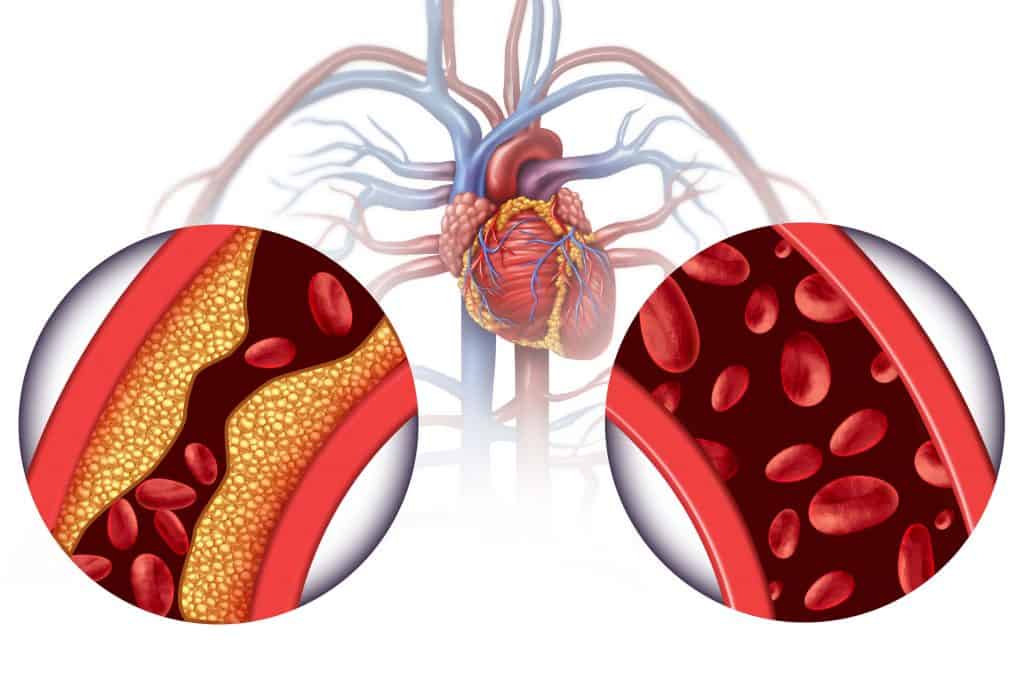 Does Aspirin Help with Cholesterol