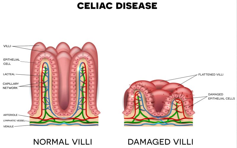 Celiac disease affected small intestine villi on a white background. Healthy villi and unhealthy villi with damaged cells