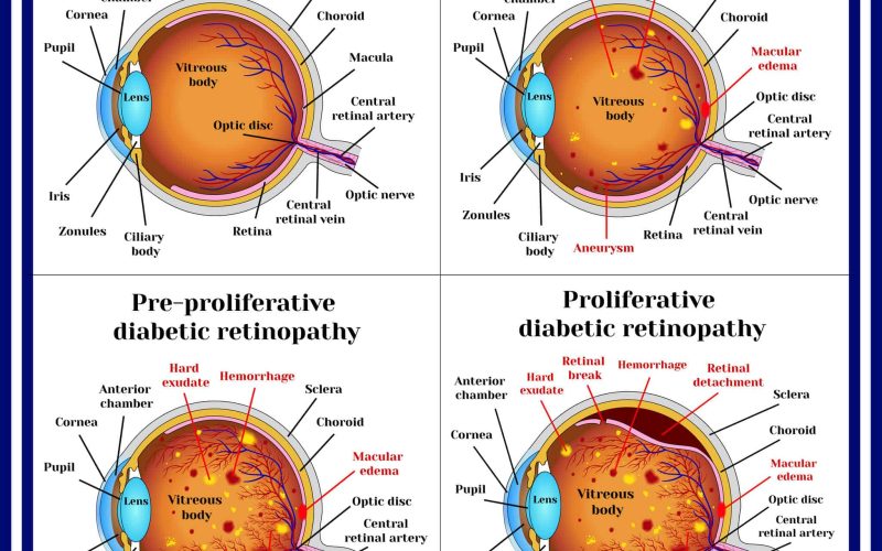 Types of diabetic retinopathy: non-proliferative, pre-proliferative diabetic retinopathy, proliferative retinopathy of retina.