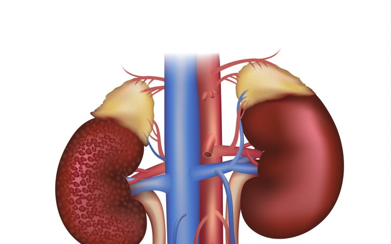 Diabetic Nephropathy, kidney disease caused by Diabetes