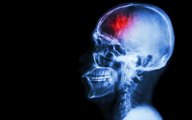 31823570 - "stroke" (cerebrovascular accident). film x-ray skull lateral with stroke and blank area at left side