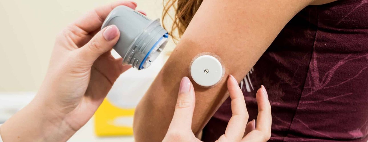 Medical device for glucose check. Continuous glucose monitoring pod. Modern wireless technology in medicine.